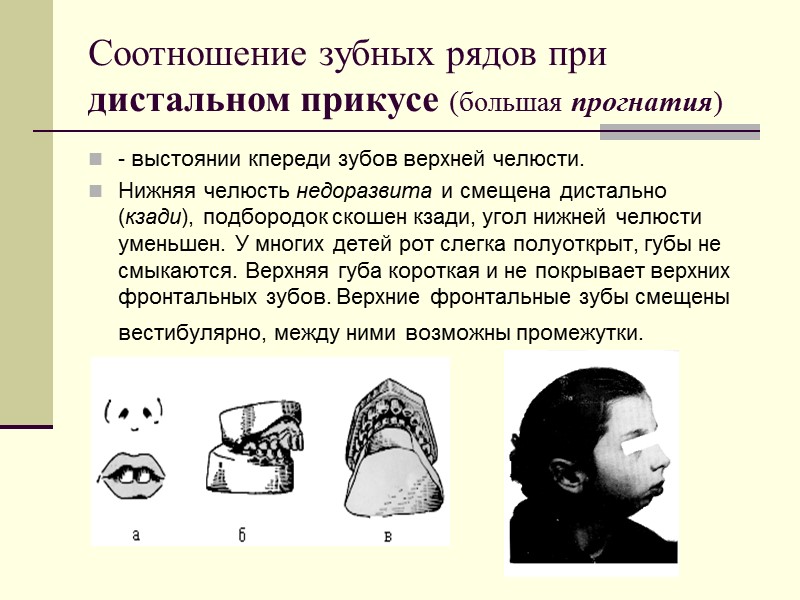Соотношение зубных рядов при дистальном прикусе (большая прогнатия) - выстоянии кпереди зубов верхней челюсти.